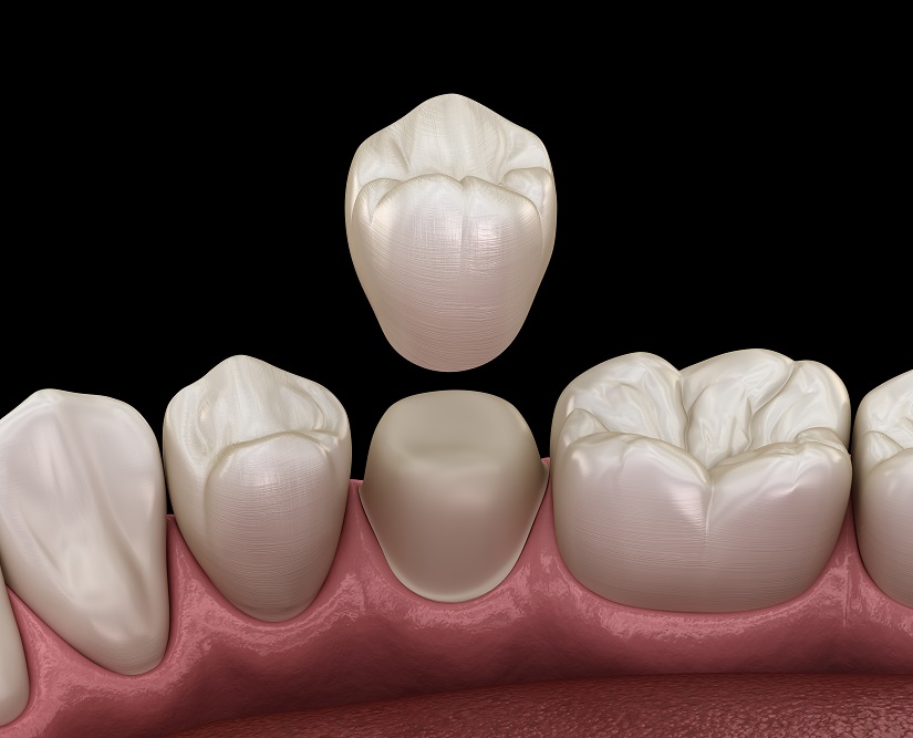 Dental Crowns