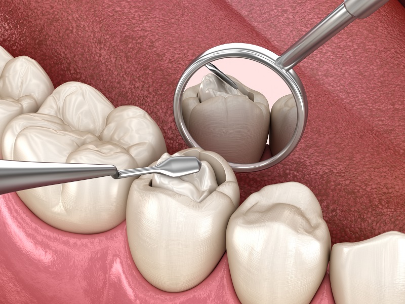 Composite Fillings